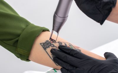 Unlocking Clear Skin: The Role of Laser Technology in Tattoo Removal for HEALTH AND SKINCARE / SOMATOLOGY Therapists