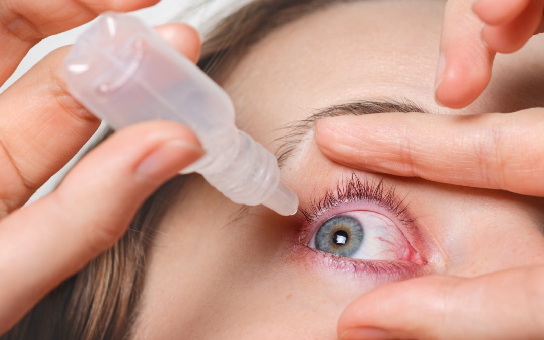 Navigating Allergies and Sensitivities: Understanding Lash Extensions and Your Eyes in HEALTH AND SKINCARE / SOMATOLOGY / BEAUTY AND NAILS / HAIR AND BEAUTY / COSMETOLOGY / PROFESSIONAL MAKE-UP ARTISTRY
