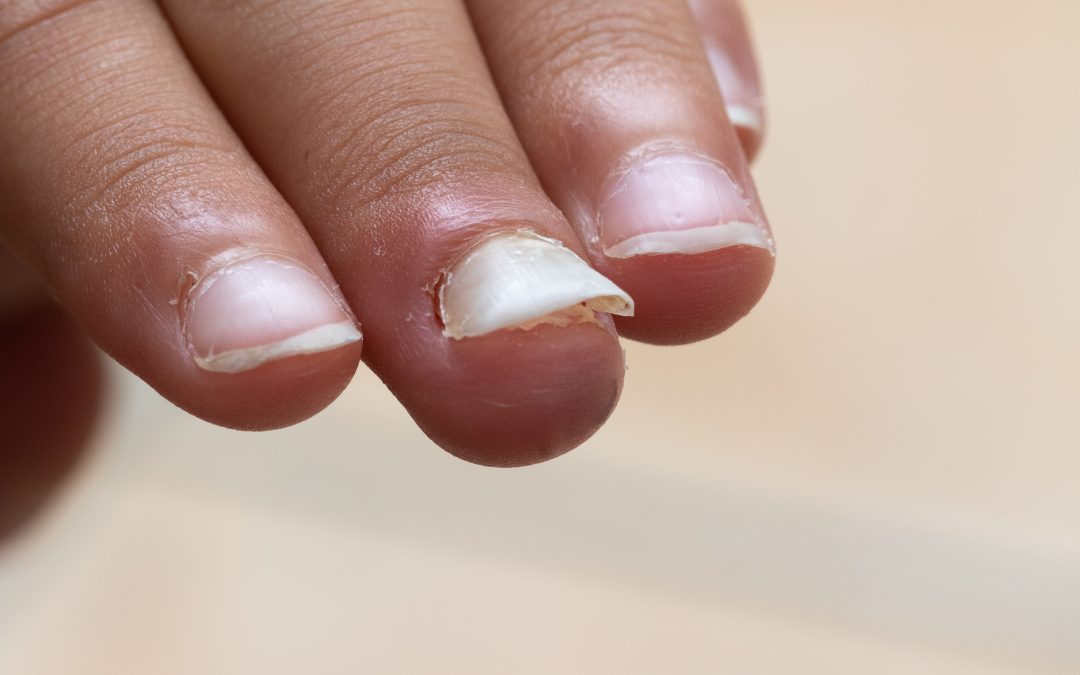 Nail Fungus: Identification and Treatment Tips in HEALTH AND SKINCARE / SOMATOLOGY / BEAUTY AND NAILS / HAIR AND BEAUTY / COSMETOLOGY / PROFESSIONAL MAKE-UP ARTISTRY