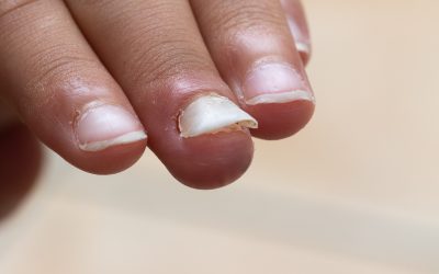 Nail Fungus: Identification and Treatment Tips in HEALTH AND SKINCARE / SOMATOLOGY / BEAUTY AND NAILS / HAIR AND BEAUTY / COSMETOLOGY / PROFESSIONAL MAKE-UP ARTISTRY