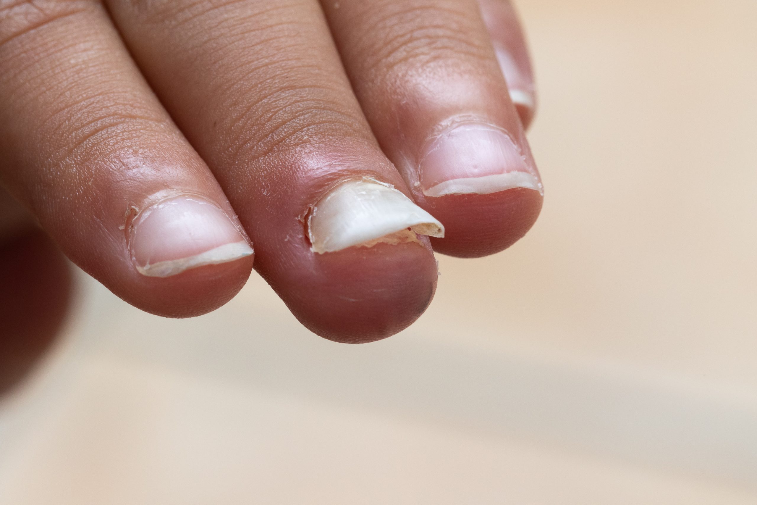 fingers of a child who is losing a fingernail