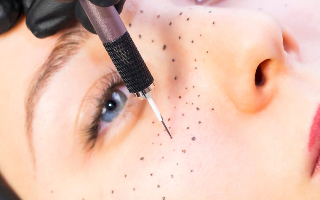 FRECKLE TATTOOS IN HEALTH AND SKINCARE / SOMATOLOGY / BEAUTY AND NAILS / HAIR AND BEAUTY / COSMETOLOGY / PROFESSIONAL MAKE-UP ARTISTRY