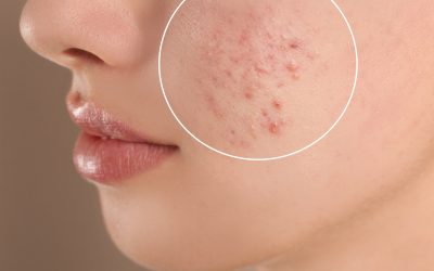 Decoding Acne: Unveiling Types and Treatments for Holistic HEALTH AND SKINCARE / SOMATOLOGY