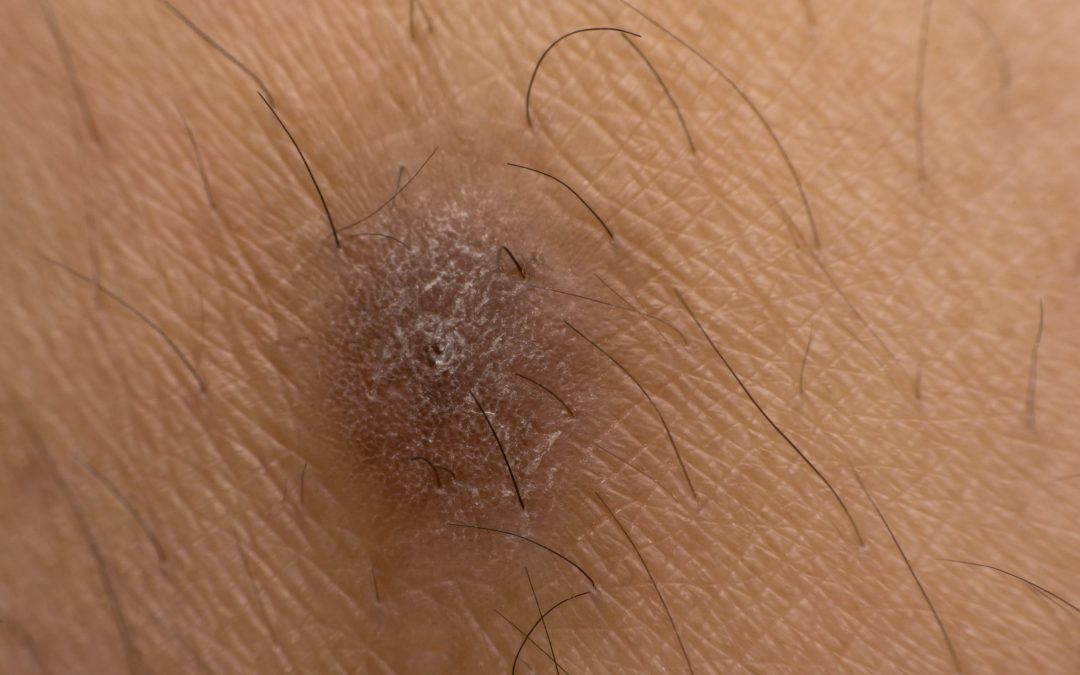 Everyone’s worst nightmare: Ingrown hairs in HEALTH AND SKINCARE / SOMATOLOGY / BEAUTY AND NAILS / HAIR AND BEAUTY / COSMETOLOGY